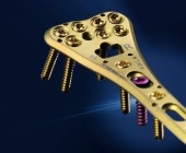 Radius Compression Plates